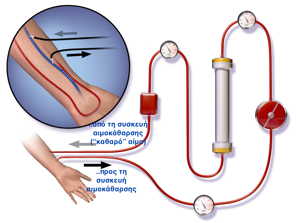 Dialysis 1