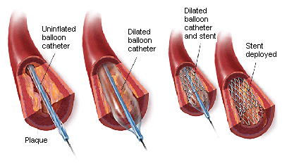 ANGIOPLASTY