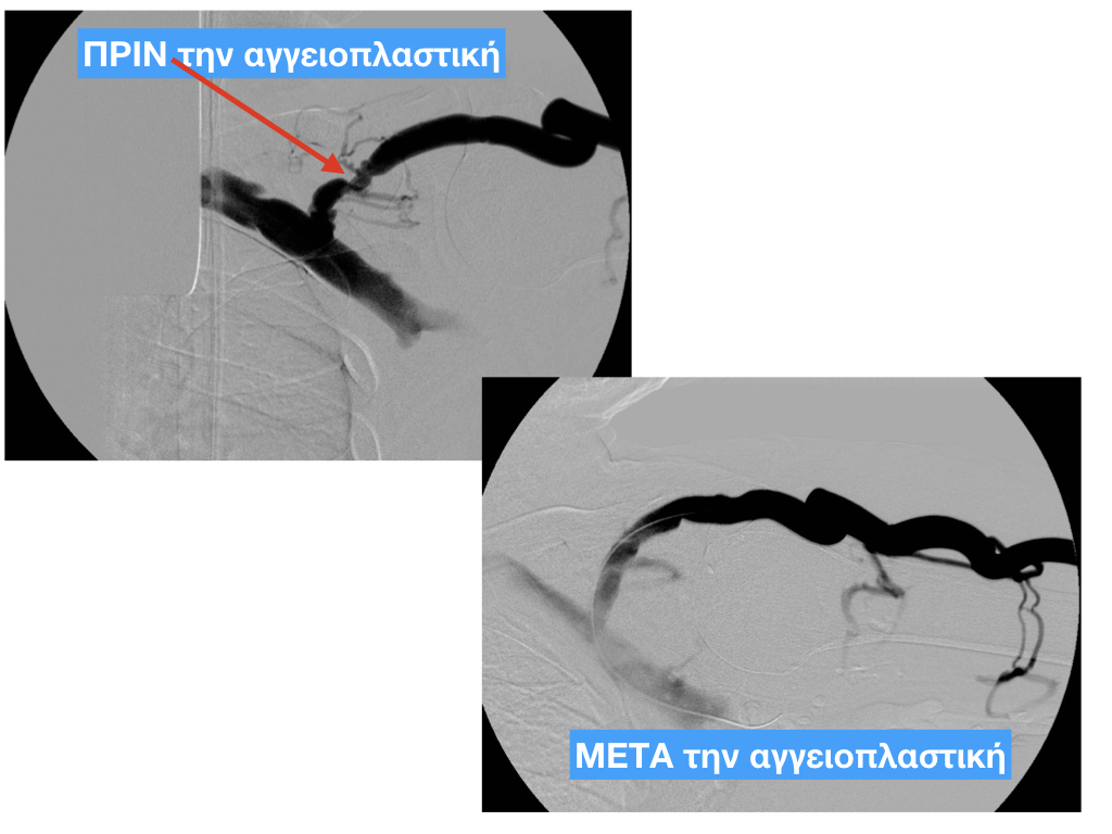 αγγειοπλαστικη φιστουλα 11