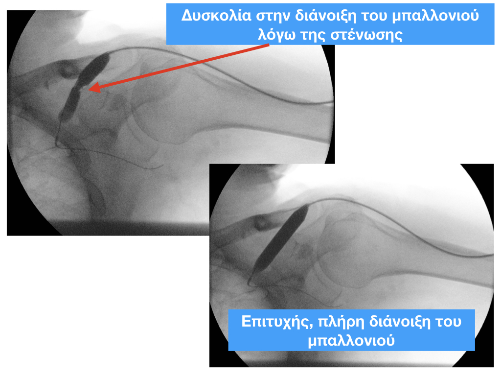 αγγειοπλαστικη φιστουλα 2