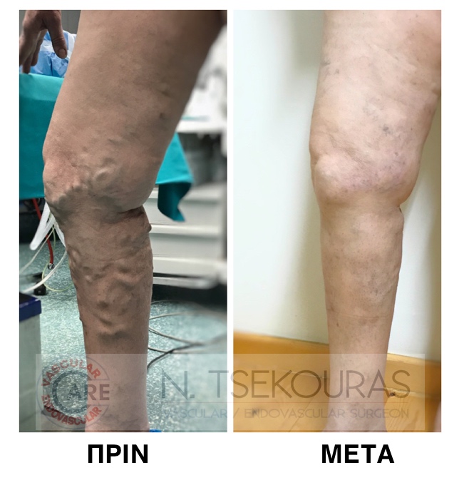 μεγάλοι κιρσοί