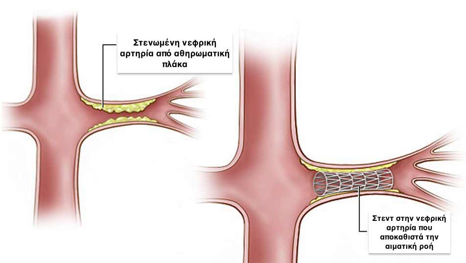 renal stenting