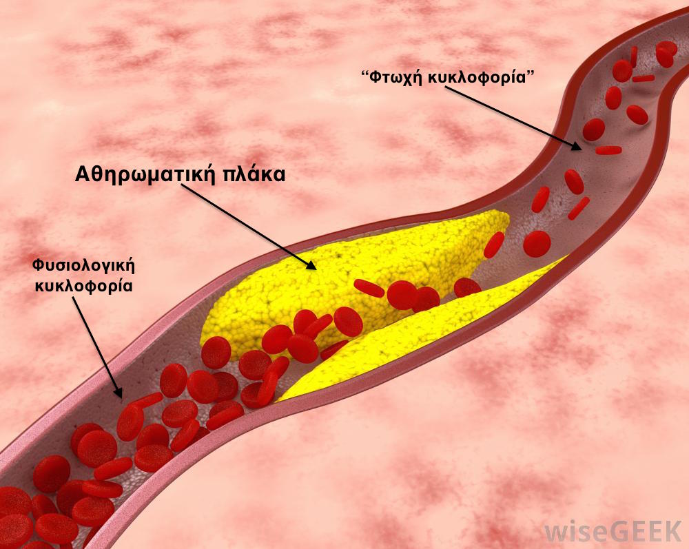 arterial ulcer