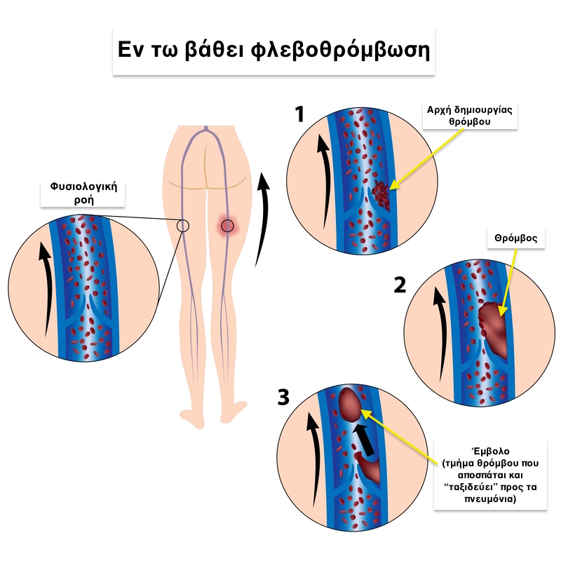 Deep Vein Thrombosis1