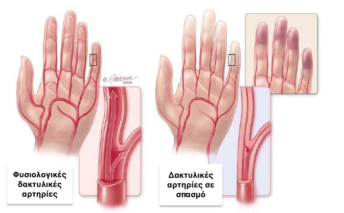 raynauds3