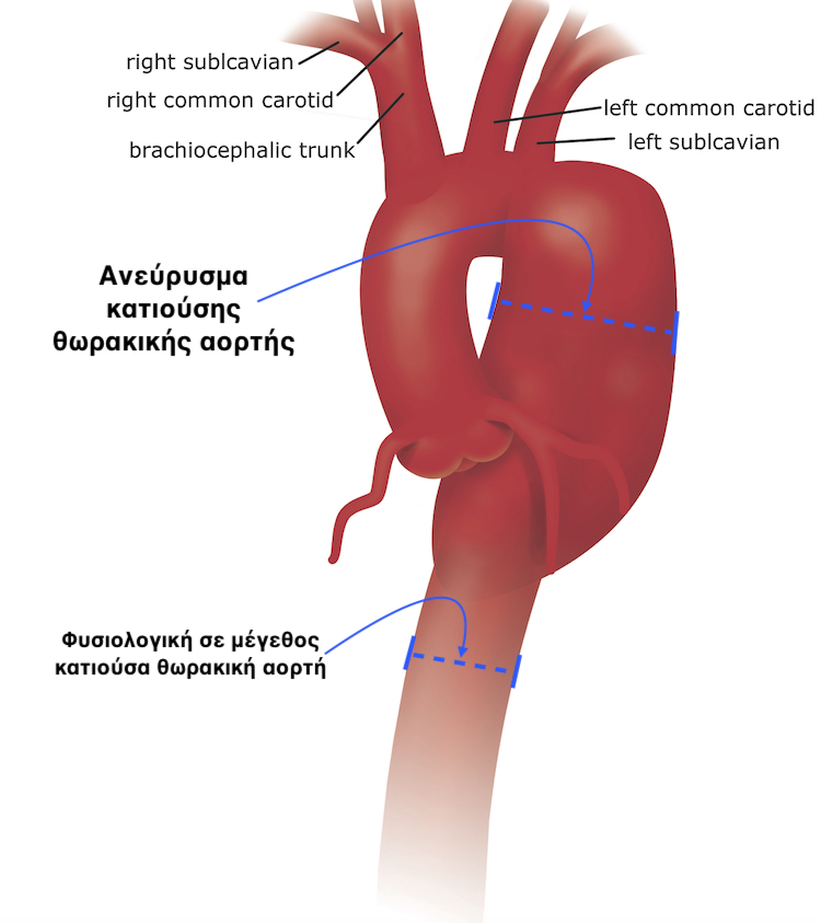 που βρισκεται η κοιλιακη αορτη