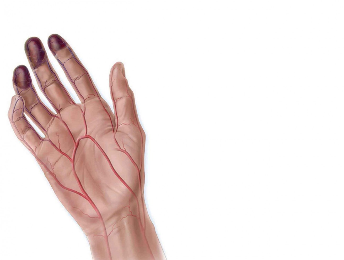 Νόσος Buerger - Αποφρακτική Θρομβαγγειίτιδα