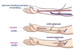 Αγγειακή Προσπέλαση: Είδη Προσπελάσεων (Φίστουλας)