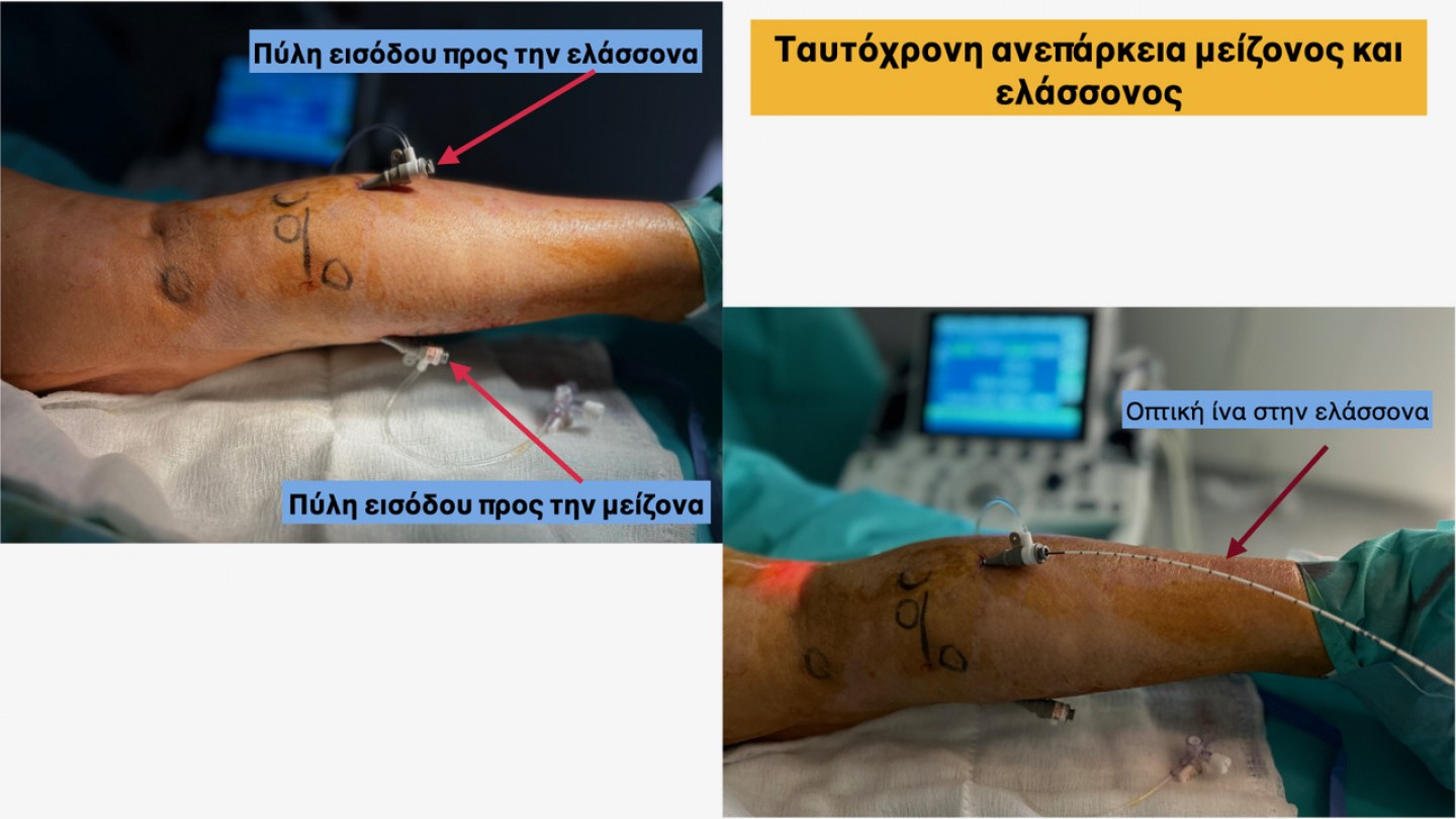 Αντιμετώπιση κιρσών στη μείζονα και την ελάσσονα σαφηνή φλέβα