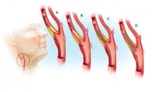 Στένωση Καρωτίδας: Απεικόνιση Ενδαγγειακής Αποκατάστασης με stent