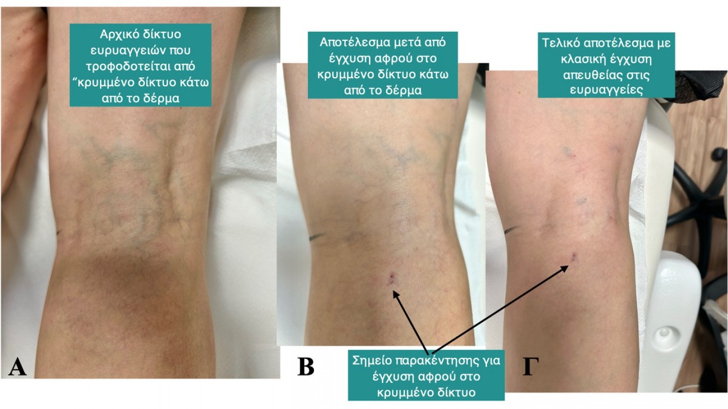 &Sigma;&kappa;&lambda;&eta;&rho;&omicron;&theta;&epsilon;&rho;&alpha;&pi;&epsilon;ί&alpha; &epsilon;&upsilon;&rho;&upsilon;&alpha;&gamma;&gamma;&epsilon;&iota;ώ&nu;: &Eta; &sigma;&eta;&mu;&alpha;&sigma;ί&alpha; &tau;&eta;&sigmaf; &chi;&alpha;&rho;&tau;&omicron;&gamma;&rho;ά&phi;&eta;&sigma;&eta;&sigmaf; &tau;&omicron;&upsilon; &delta;&iota;&kappa;&tau;ύ&omicron;&upsilon; &kappa;&alpha;&iota; &tau;&alpha; &ldquo;&kappa;&rho;&upsilon;&mu;&mu;έ&nu;&alpha;&rdquo; &delta;ί&kappa;&tau;&upsilon;&alpha;.