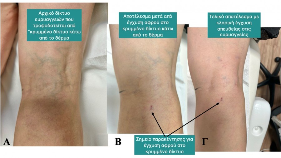 &Sigma;&kappa;&lambda;&eta;&rho;&omicron;&theta;&epsilon;&rho;&alpha;&pi;&epsilon;ί&alpha; &epsilon;&upsilon;&rho;&upsilon;&alpha;&gamma;&gamma;&epsilon;&iota;ώ&nu;: &Eta; &sigma;&eta;&mu;&alpha;&sigma;ί&alpha; &tau;&eta;&sigmaf; &chi;&alpha;&rho;&tau;&omicron;&gamma;&rho;ά&phi;&eta;&sigma;&eta;&sigmaf; &tau;&omicron;&upsilon; &delta;&iota;&kappa;&tau;ύ&omicron;&upsilon; &kappa;&alpha;&iota; &tau;&alpha; &ldquo;&kappa;&rho;&upsilon;&mu;&mu;έ&nu;&alpha;&rdquo; &delta;ί&kappa;&tau;&upsilon;&alpha;.