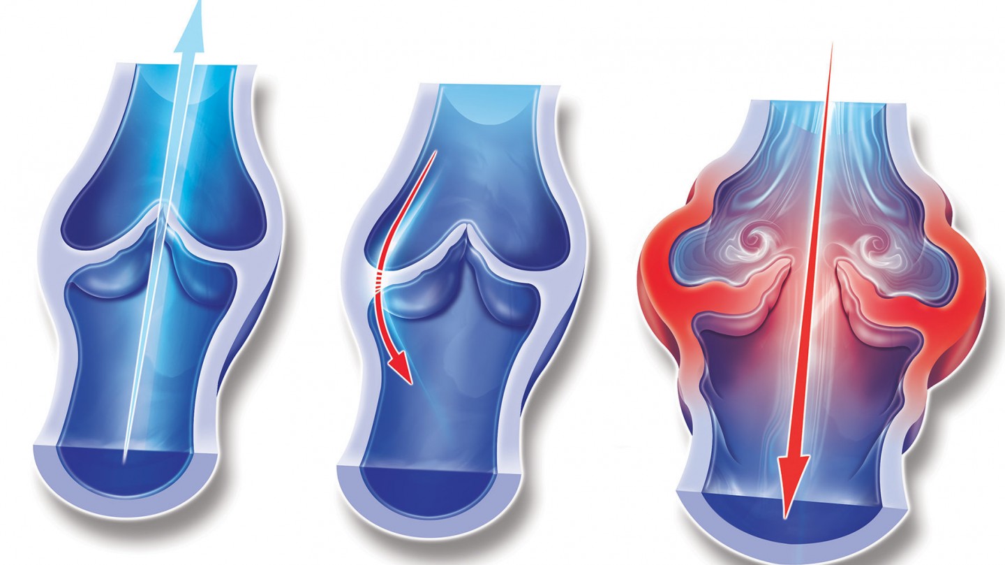 Γενικά για τις Φλεβικές Παθήσεις