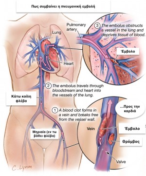 Πνευμονική Εμβολή: Απεικόνιση