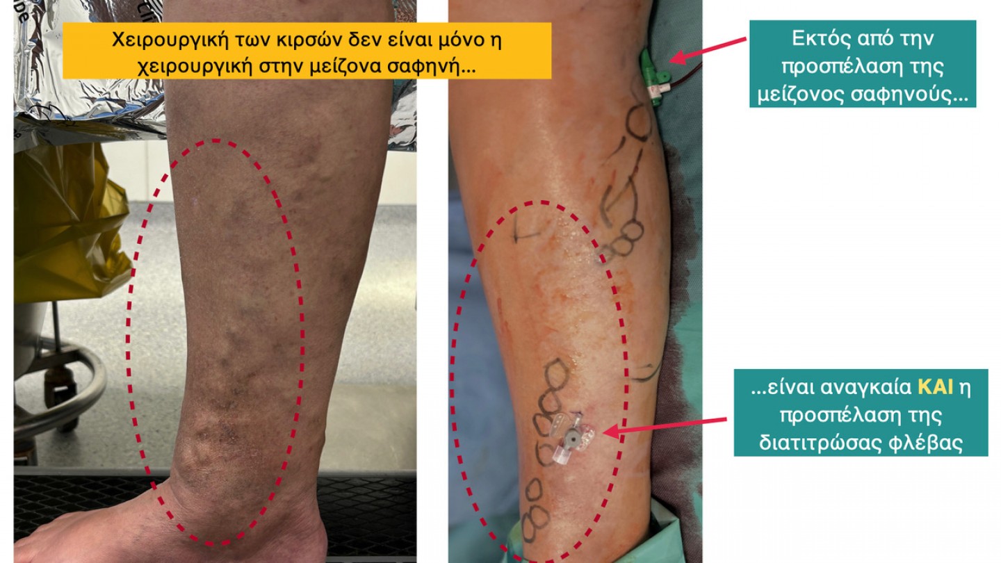 Αποκλεισμός παθολογικής διατιτρώσας φλέβας μετά από χαρτογράφηση για οριστική αντιμετώπιση κιρσών.