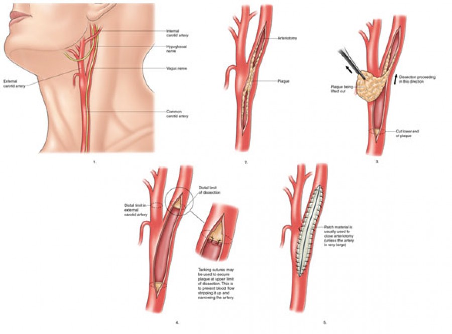 Στένωση Καρωτίδας: Απεικόνιση Ανοιχτής Χειρουργικής Αποκατάστασης (Ενδαρτηρεκτομή)
