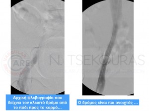 &Pi;&rho;ώ&tau;&eta; &epsilon;&pi;έ&mu;&beta;&alpha;&sigma;&eta; &sigma;&tau;&eta;&nu; &Epsilon;&lambda;&lambda;ά&delta;&alpha; &sigma;&tau;&omicron; &epsilon;&nu; &tau;&omega; &beta;ά&theta;&epsilon;&iota; &phi;&lambda;&epsilon;&beta;&iota;&kappa;ό &sigma;ύ&sigma;&tau;&eta;&mu;&alpha; &tau;&omicron;&upsilon; &kappa;ά&tau;&omega; ά&kappa;&rho;&omicron;&upsilon; &gamma;&iota;&alpha; &alpha;&nu;&tau;&iota;&mu;&epsilon;&tau;ώ&pi;&iota;&sigma;&eta; &sigma;&omicron;&beta;&alpha;&rho;&omicron;ύ &mu;&epsilon;&tau;&alpha;&theta;&rho;&omicron;&mu;&beta;&omega;&tau;&iota;&kappa;&omicron;ύ &sigma;&upsilon;&nu;&delta;&rho;ό&mu;&omicron;&upsilon;