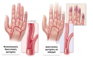 Σύνδρομο Raynaud
