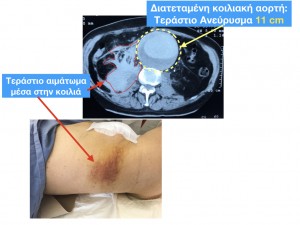 &Rho;ή&xi;&eta; &Mu;&epsilon;&gamma;ά&lambda;&omicron;&upsilon; &Alpha;&nu;&epsilon;&upsilon;&rho;ύ&sigma;&mu;&alpha;&tau;&omicron;&sigmaf; &Kappa;&omicron;&iota;&lambda;&iota;&alpha;&kappa;ή&sigmaf; &Alpha;&omicron;&rho;&tau;ή&sigmaf;