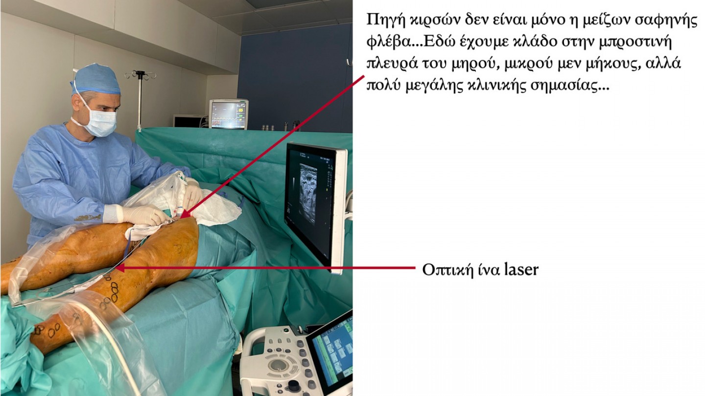 Η αντιμετώπιση όλων των πηγών ανεπάρκειας το κλειδί για την οριστική λύση στο πρόβλημα των κιρσών.