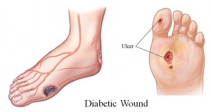 Διαβητικό Πόδι: Απεικόνιση Ελκών (Πληγών)