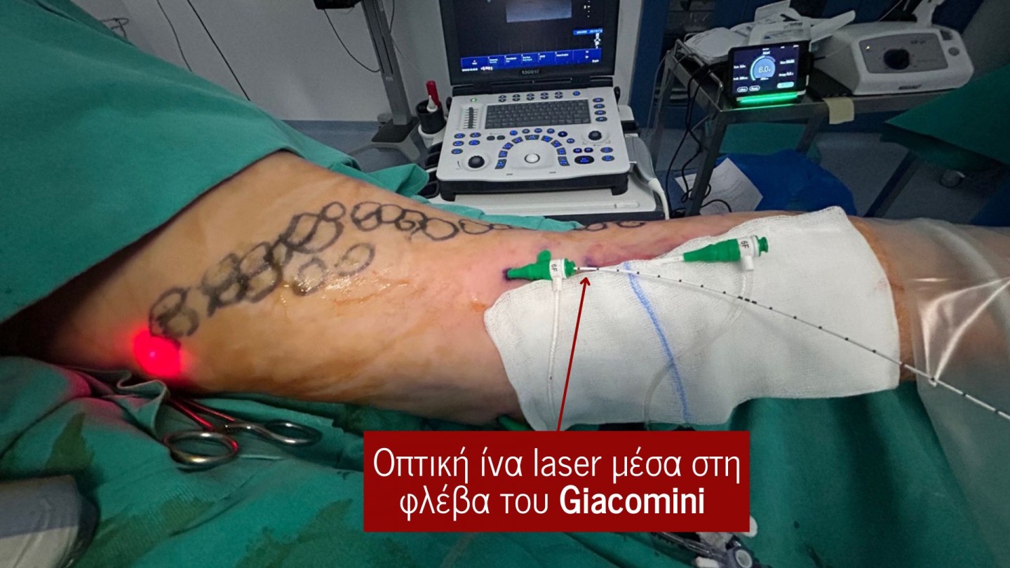 Φλέβα του Giacomini: Μία πηγή κιρσών που δεν πρέπει ποτέ να παραβλέπεται