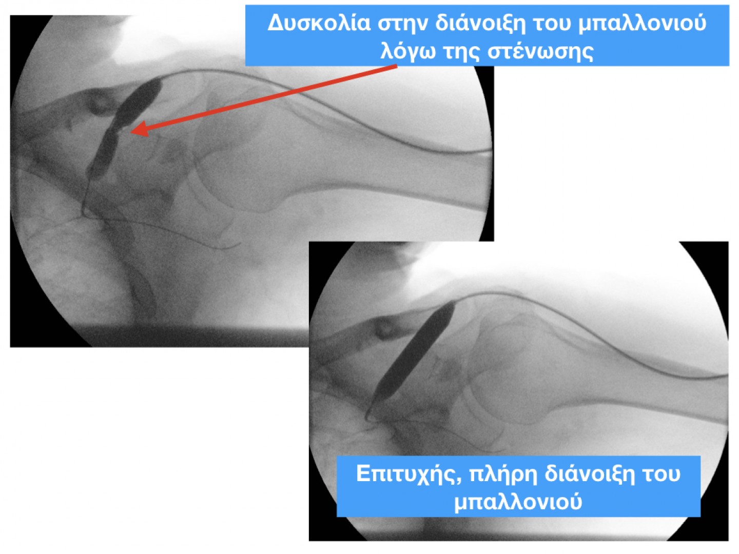 Στενωμένη φίστουλα στο χέρι - Ενδαγγειακή Αντιμετώπιση