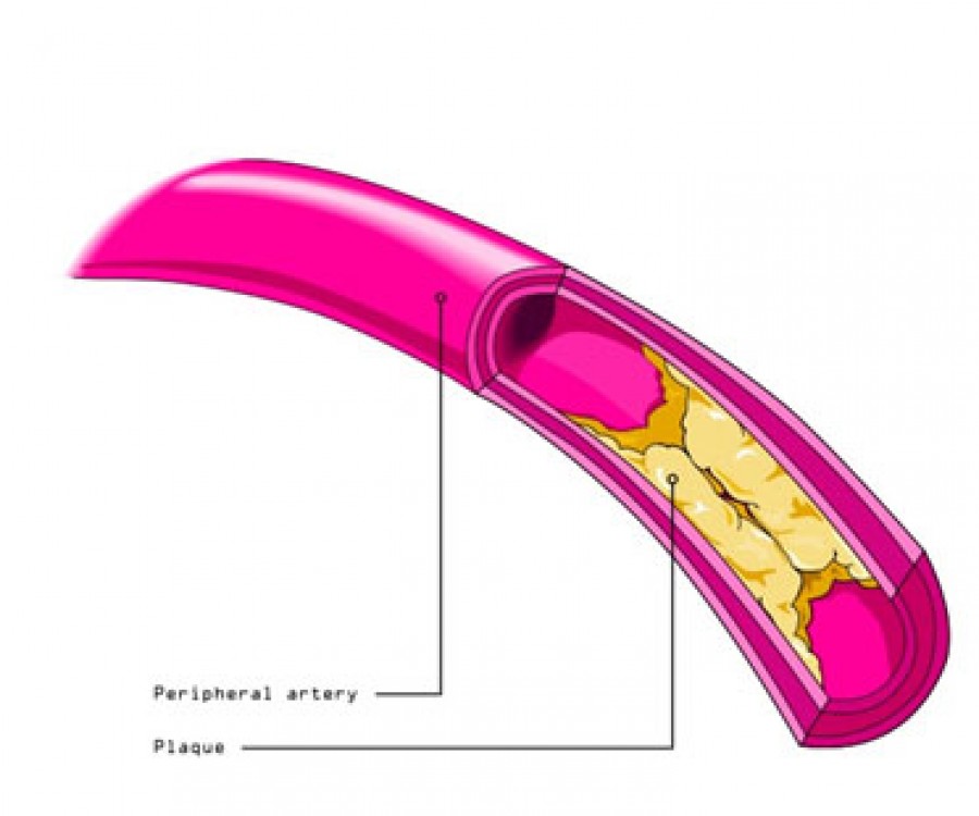 Περιφερική Αγγειοπάθεια: Απεικόνιση Αθηρωματικής Πλάκας