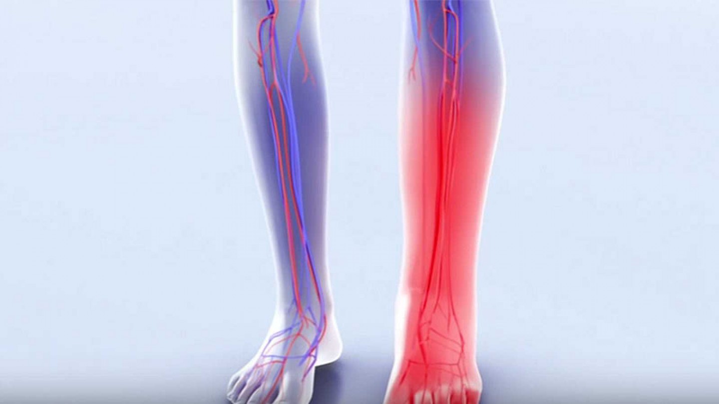 &Omicron;&xi;&epsilon;ί&alpha; &epsilon;&nu; &tau;&omega; &beta;ά&theta;&epsilon;&iota; &phi;&lambda;&epsilon;&beta;&iota;&kappa;ή &theta;&rho;ό&mu;&beta;&omega;&sigma;&eta;. &Tau;&iota; &pi;&rho;έ&pi;&epsilon;&iota; &nu;&alpha; &kappa;ά&nu;&omega; &mu;&epsilon;&tau;ά &tau;&eta;&nu; &delta;&iota;ά&gamma;&nu;&omega;&sigma;&eta;;