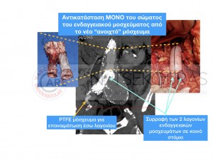 &Alpha;&nu;&tau;&iota;&kappa;&alpha;&tau;ά&sigma;&tau;&alpha;&sigma;&eta; &epsilon;&nu;&delta;&alpha;&gamma;&gamma;&epsilon;&iota;&alpha;&kappa;&omicron;ύ &alpha;&omicron;&rho;&tau;&iota;&kappa;&omicron;ύ &mu;&omicron;&sigma;&chi;&epsilon;ύ&mu;&alpha;&tau;&omicron;&sigmaf; (&gamma;&iota;&alpha; &alpha;&nu;&epsilon;ύ&rho;&upsilon;&sigma;&mu;&alpha;) &mu;&epsilon; &kappa;&lambda;&alpha;&sigma;&iota;&kappa;ό "&alpha;&nu;&omicron;&iota;&chi;&tau;ό" &mu;ό&sigma;&chi;&epsilon;&upsilon;&mu;&alpha;